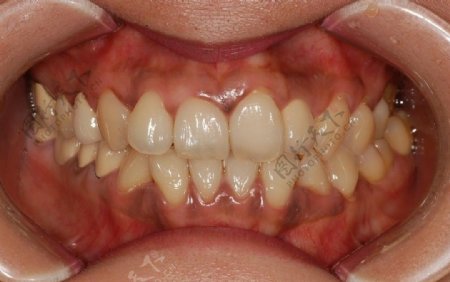 口腔牙龈美白之前图片