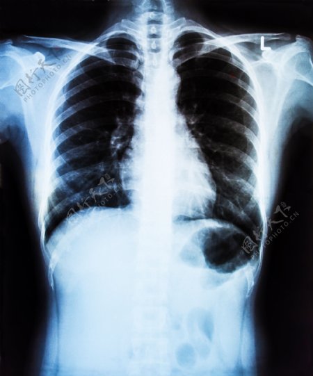 人体胸部X光片图片