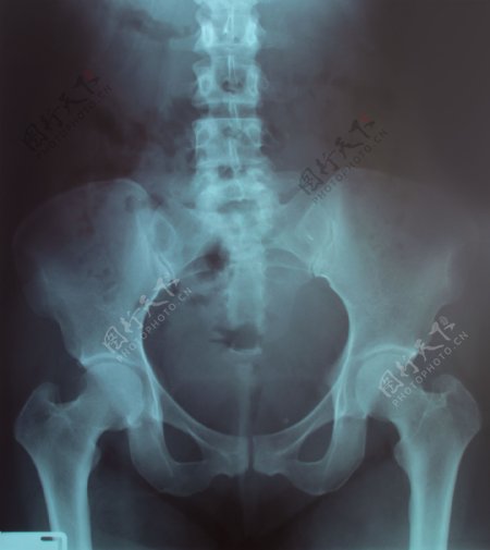 盆腔X光片图片