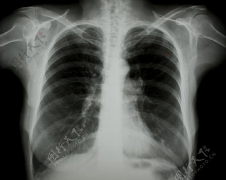 胸部X光片图片