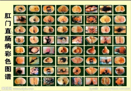 肛门直肠彩色图谱图片