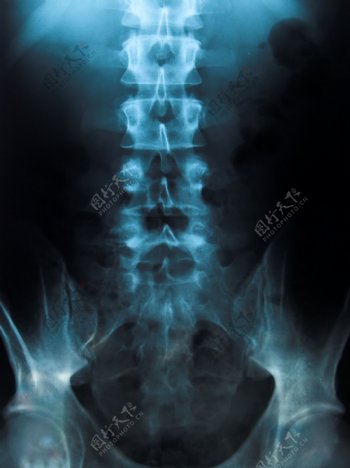 脊椎CT片图片